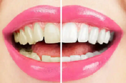 皓齒美白套裝、瓷貼面/超薄貼面